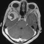 Brain Tumor Classification